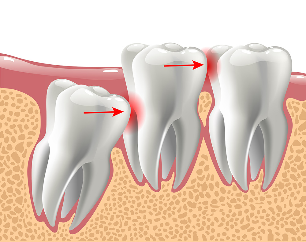 realistic 3D teeth, and wisdom tooth problems, oral anatomy
