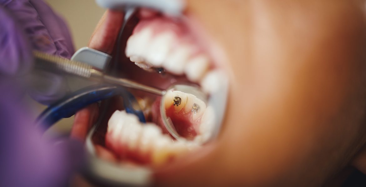 Lingual Braces Checkup Cropped shot of a beautiful young woman is at the dentist. She sits in the dentist's chair and the dentist check aesthetic self-aligning lingual locks on her teeth putting.