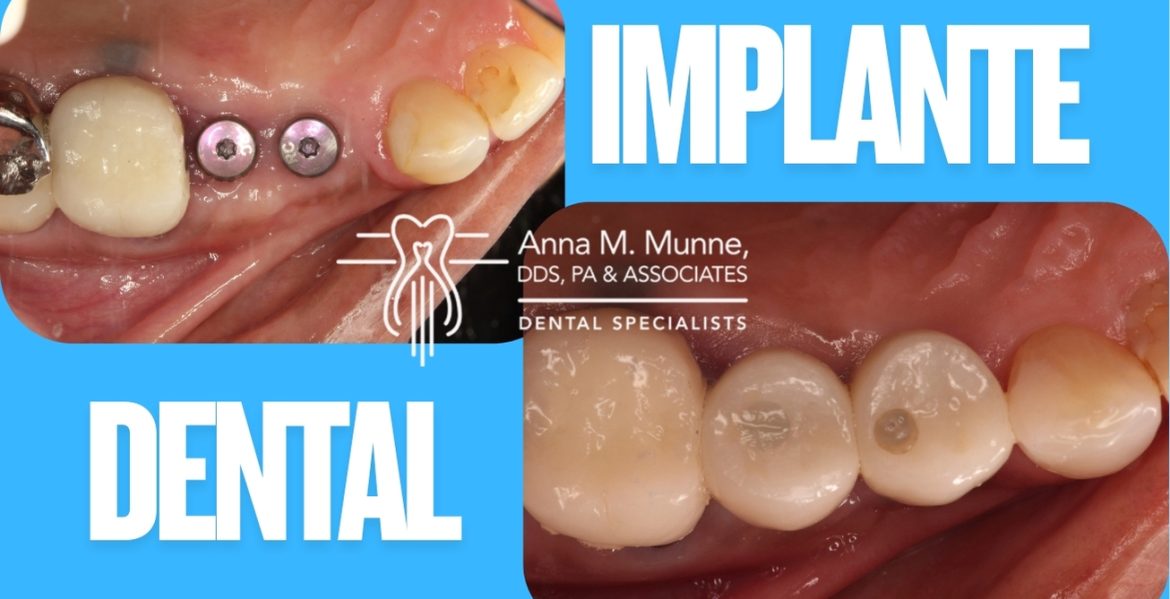 Implante Dental