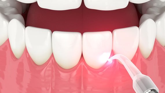 3d render of dental diode laser used to treat gums. The concept of using laser therapy in the treatment of gums