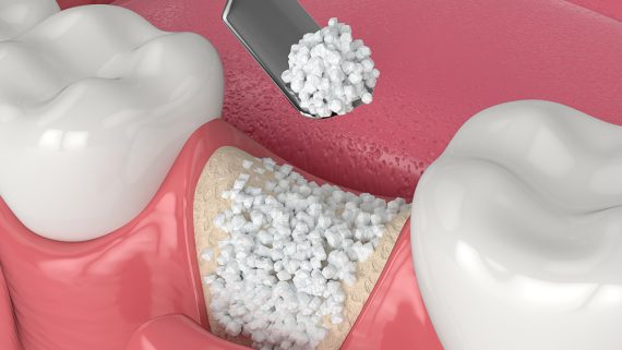 3D render of dental bone grafting with bone biomaterial application over white background. Jaw bone augmentation concept.