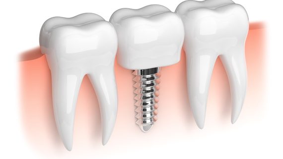 Model of white teeth and dental implant