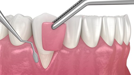 Gum Recession: Soft tissue graft surgery. 3D illustration of Dental  treatment