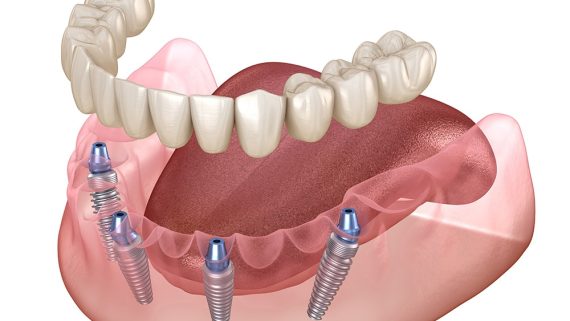 Mandibular prosthesis All on 4 system supported by implants. Medically accurate 3D illustration of human teeth and dentures concept