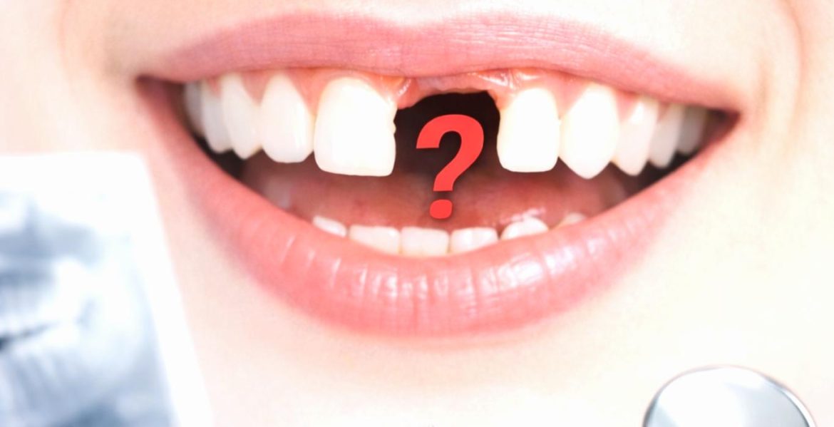 missing_tooth_lighter_web (1)