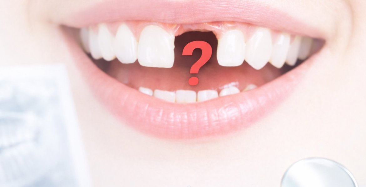 perdiste un diente Dr Anna Munne DDS