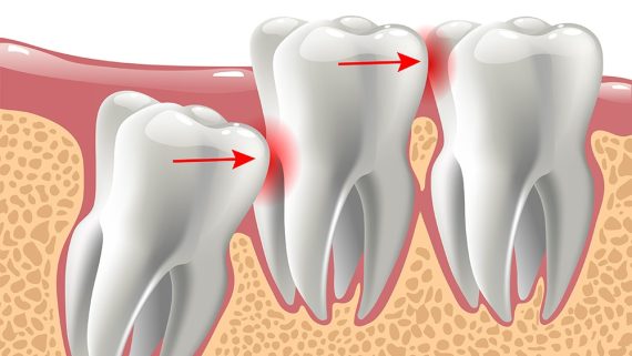 realistic 3D teeth, and wisdom tooth problems, oral anatomy